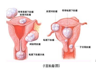 名医在线解析 子宫肌瘤有哪些症状